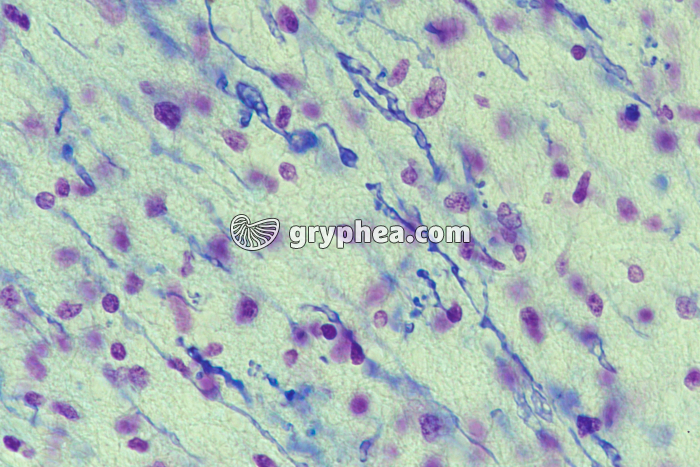 Sclérose en plaques - Substance blanche du cerveau avec fibres nerveuses dont la gaine de myéline est altérée x160 - gryphea.com